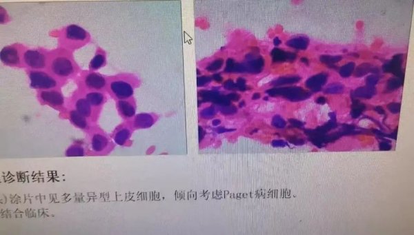 云资管 以为是湿疹，结果竟是癌！医生：很多人去错科室